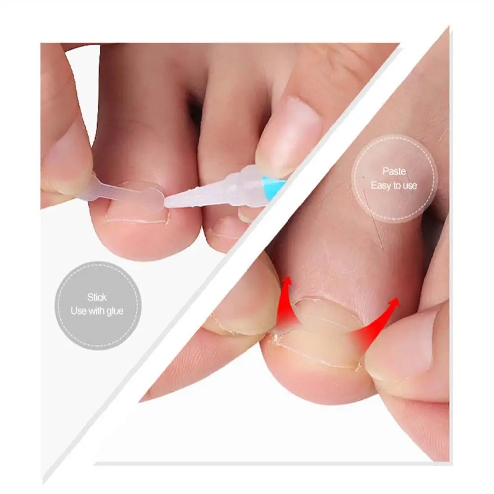 Paronişi Ortez Pedikür yama Düzeltme Sticker Batık Ayak Tırnaklarını Çıkartmalar Tırnak Düzeltme Tabletleri Ayak Tırnağı Orto Sticker